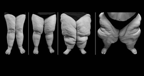 Lipedema, doença crônica que atinge uma em cada dez mulheres no mundo