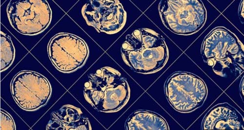 Sintoma de Parkinson que 'congela' movimento pode ser contido com tratamento desenvolvido no Brasil