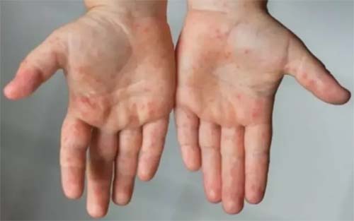 Pós-Covid: pediatra e mães relatam caminho, do diagnóstico à superação da SIM-P, doença que atingiu 77 crianças em AL