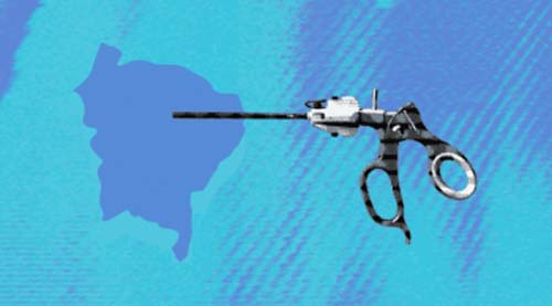 Em Alagoas, instrumento para cirurgia menos invasiva ainda é escasso no SUS