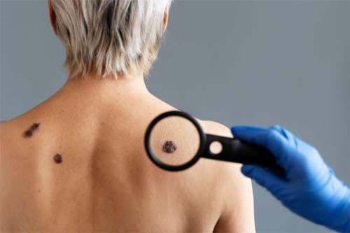 Nova imunoterapia apresenta regressão de 31,5% em melanoma