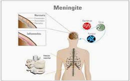 Casos de meningite aumentam em Alagoas