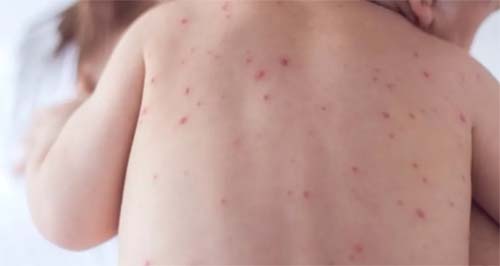 Ministério da Saúde enviará representantes a Maceió após aumento de casos de meningite