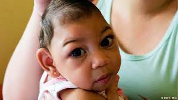 Pesquisa mostra correlação entre desnutrição materna e microcefalia