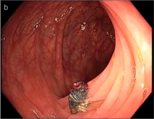 Mosca viva em intestino de paciente surpreende médicos durante colonoscopia