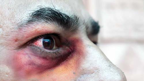 Mucormicose: Infecção rara mutila e mata doentes com Covid-19 na Índia