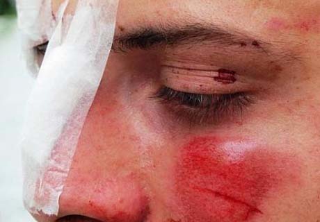 Jovem é agredida com mordida na bochecha ao negar programa