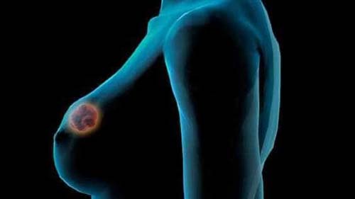 Câncer de mama: os riscos da quimioterapia tardia