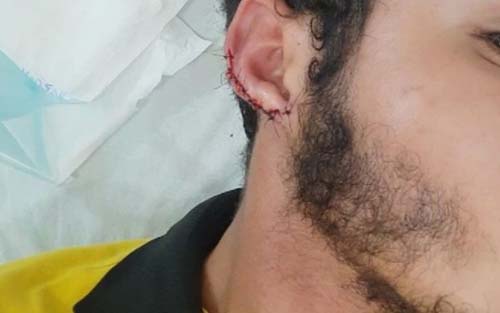 Cliente morde e arranca parte de orelha de funcionário de lanchonete no Sertão de Alagoas