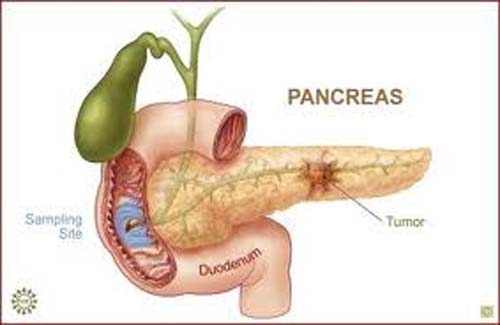 Diabetes pode ser presságio para tumor típico de câncer de pâncreas