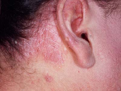 Dia Mundial da Psoríase: dermatologistas alertam que doença não é contagiosa e pedem fim do preconceito