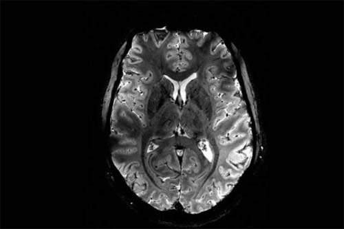 Exame simples pode detectar Alzheimer até 9 anos antes dos sintomas