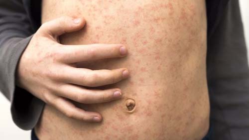 3 números que revelam o assustador avanço do sarampo no mundo