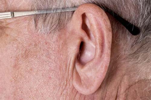 Sinal na Orelha Pode Indicar Possíveis Riscos Cardíacos? Especialistas Aconselham Cautela