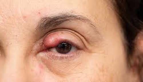 Cuidados Essenciais para Prevenir a Inflamação nas Pálpebras durante o Verão