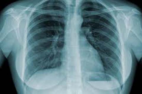 Dia Mundial da Tuberculose alerta sobre tratamento da doença