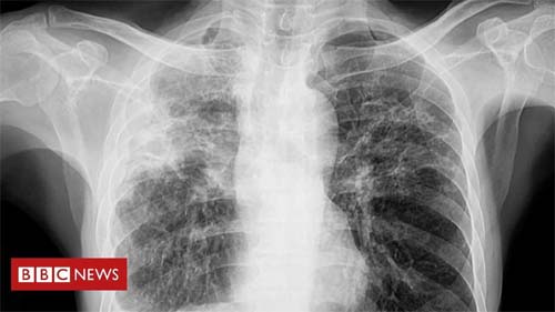 Tuberculose pulmonar ultrapassa fronteiras de presídios e favelas no Brasil