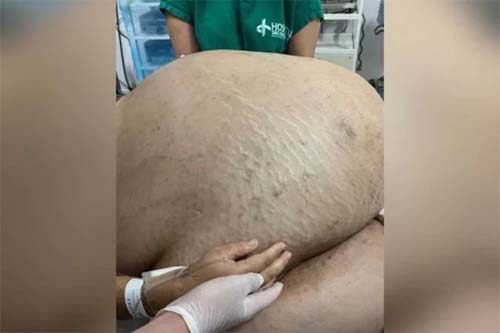 Morre mulher que teve tumor de 46 kg retirado em cirurgia de emergência em Itaperuna, no RJ