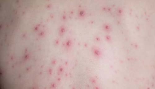 Quatro casos suspeitos de Varíola dos Macacos são descartados e Alagoas tem 10 em investigação
