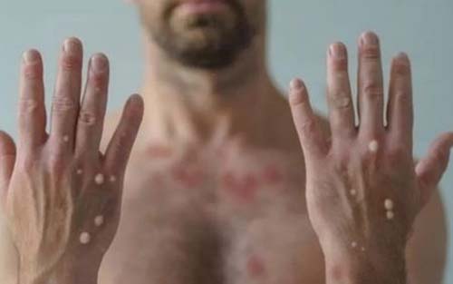 Alagoas tem 30 casos suspeitos de varíola dos macacos