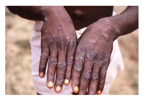 Especialistas alertam que controle da varíola dos macacos é cada vez mais difícil