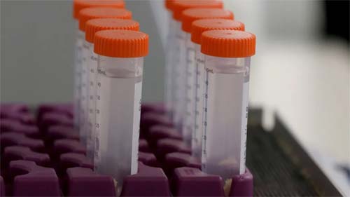Avanço na luta contra o Alzheimer: reposição de vitamina C no cérebro mostra potencial terapêutico