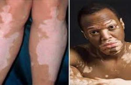 Você sabe quais possibilidades de tratamento para quem tem vitiligo? 